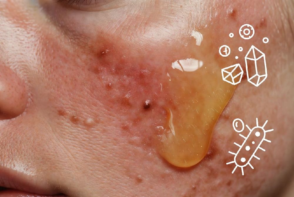 عوارض عسل بر پوست و تشدید آکنه با مصرف زیاد | پرهلو