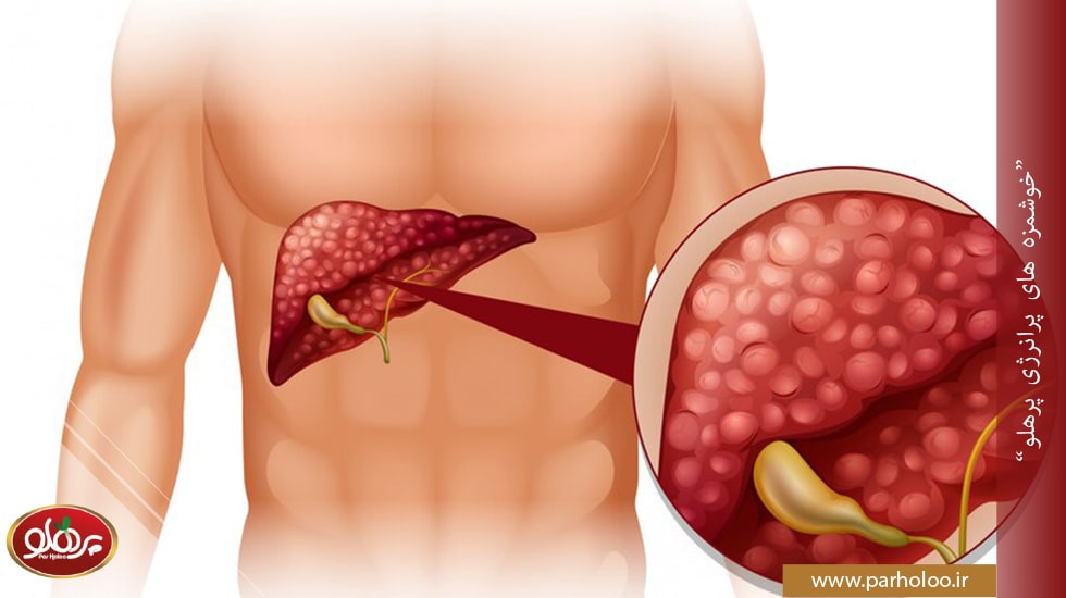 بیماری کبد چرب چیست؟-پرهلو